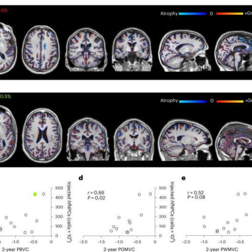 Transplanting stem cells from fetuses into people with MS reduces markers in early-stage trial