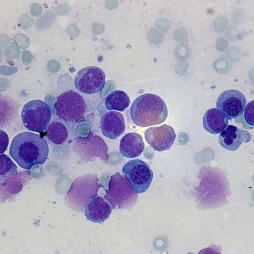 New insights into the genetic basis of leukemia