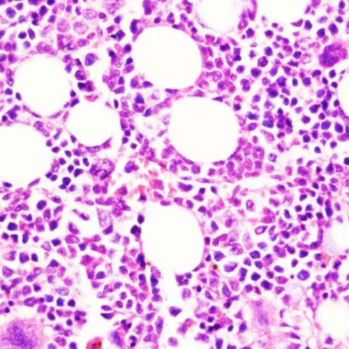 Study reveals how chronic blood cancer transitions to aggressive disease