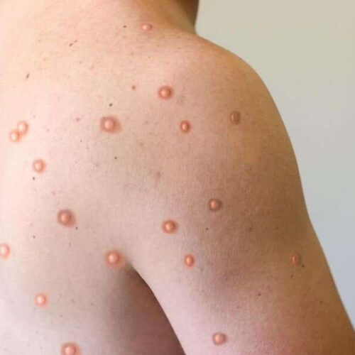 Fewer symptoms for mpox infection seen after vaccination