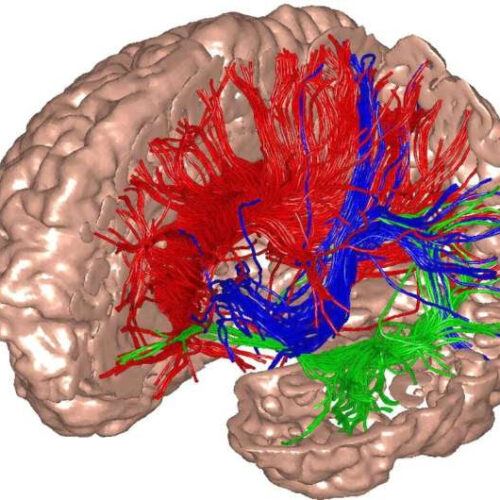 Ketamine found to increase brain noise