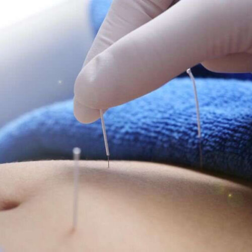 Acupuncture may aid irritable bowel syndrome with diarrhea