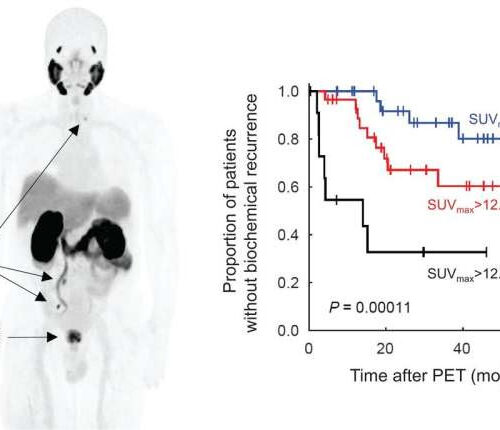 PET/MRI accurately predicts risk of prostate cancer recurrence after prostatectomy