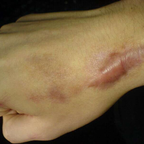 Excessive scarring shown to be associated with atopic eczema, hypertension and musculoskeletal diseases