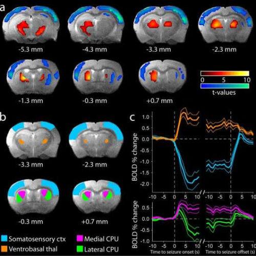 Study identifies neuronal basis of impaired consciousness in ‘absence’ epilepsy