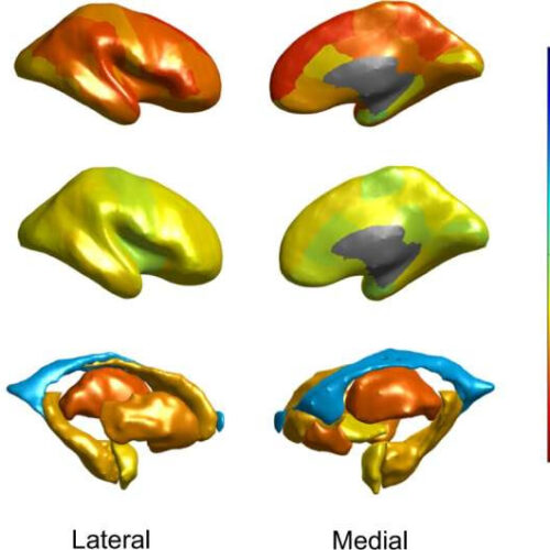 Study examines brain aging in people with schizophrenia