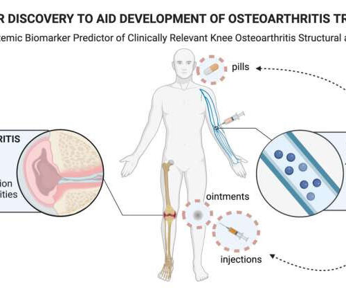 New blood test is more accurate in identifying osteoarthritis progression