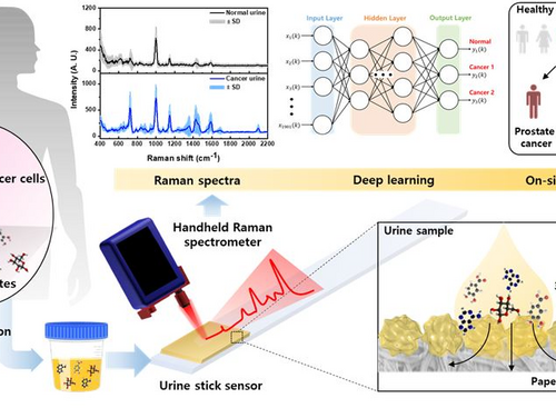 Raman-Based Urine Sensor Detects Cancer Metabolites