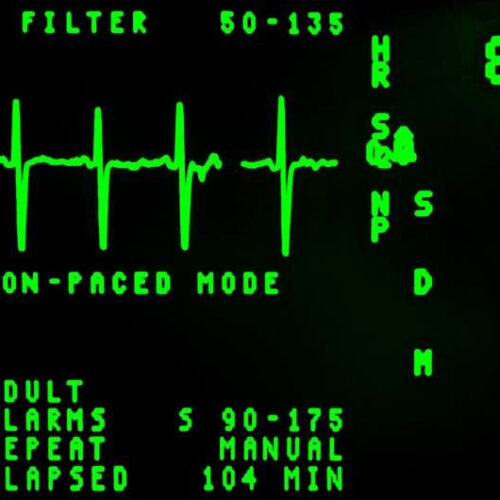 Speeding up heart rate helps heart failure patients with stiff hearts