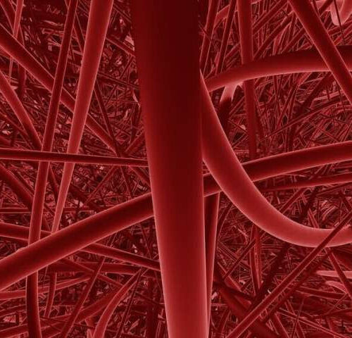 Bone marrow transplant may halt brain blood vessel disease in adults with sickle cell disease