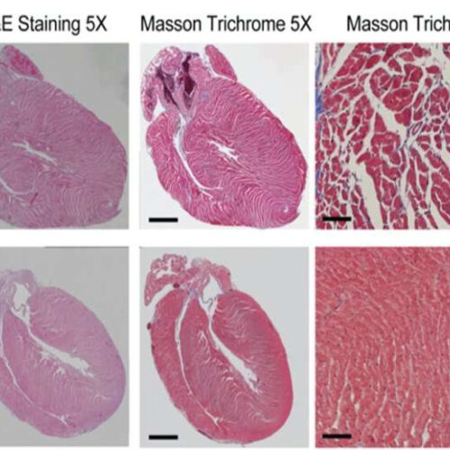 How COVID-19 can impact the heart