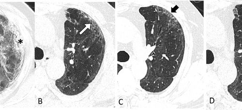 Chest CT shows lung abnormalities two years after COVID