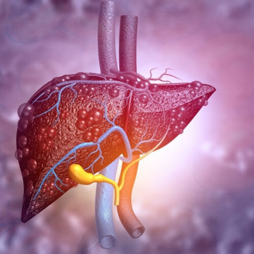 The efficiency of lifestyle intervention, orlistat, and experimental diet therapy in patients with obesity and metabolic-associated fatty liver disease