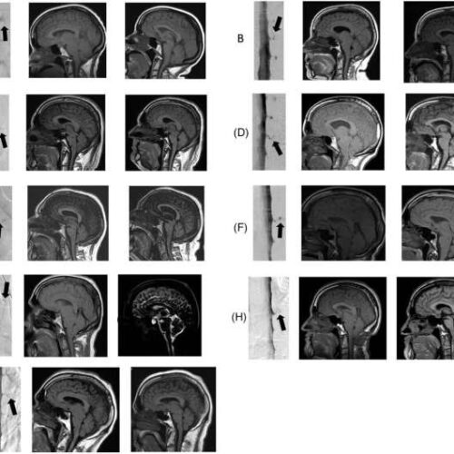 New research detects potential hidden cause of dementia