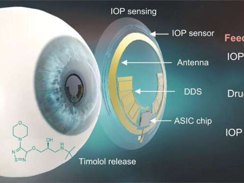 A smart contact lens that diagnoses and treats glaucoma