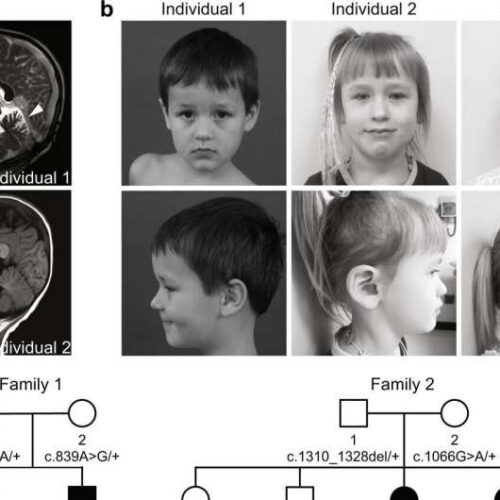 Scientists discover a rare neurological disease involving cellular recycling