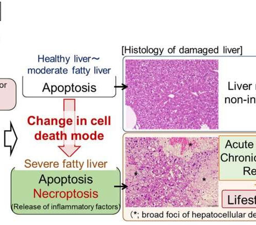 Why severe fatty liver leads to liver damage