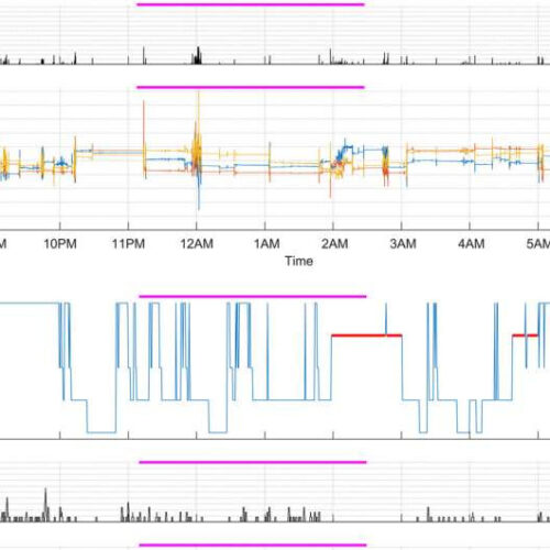 Researchers develop one of the first sleep screening methods using wearables to predict, detect Parkinson’s onset