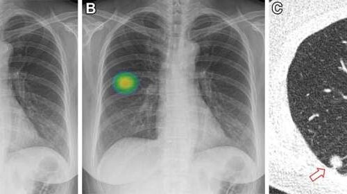 AI improves lung nodule detection on chest X-rays