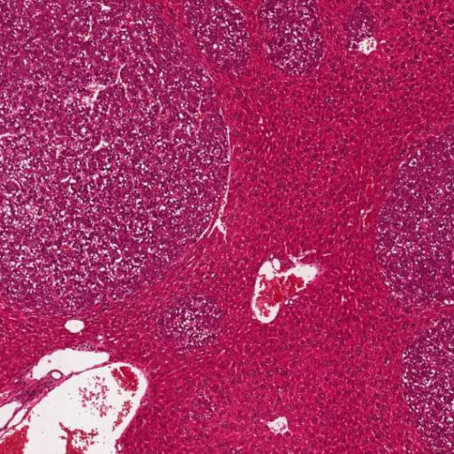 Liver cancer research: Iron-dependent cell death could be key to novel combination therapies