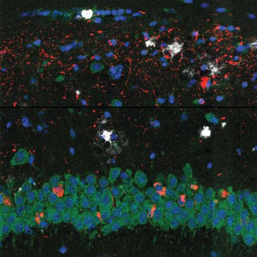 Researchers map brain cell changes in Alzheimer’s disease