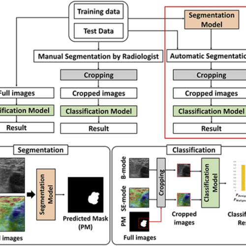 AI-powered ultrasound imaging that detects breast cancer