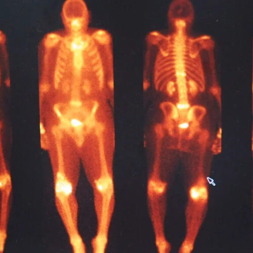 How common is cardiac amyloidosis? Bone scan study looks at prevalence and impact