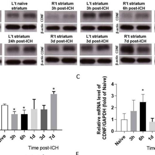 A new way to remove waste from the brain after hemorrhage