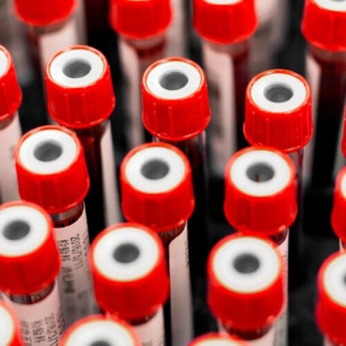 A protein test may be more accurate in predicting heart disease than cholesterol levels