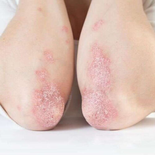 Psoriasis tied to elevated risk for celiac disease