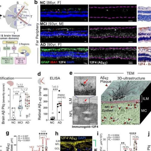 New insights into eye damage in Alzheimer’s disease patients