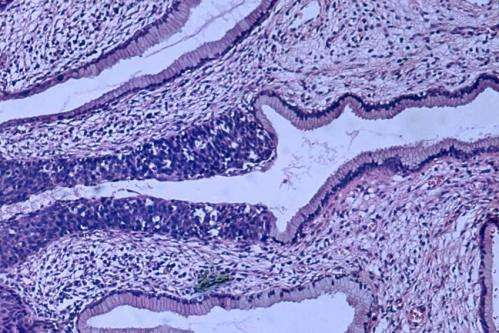 Boosting the effects of a particular microRNA may benefit patients with cervical cancer