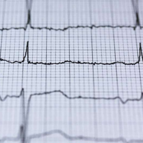 Could having an irregular heart rhythm affect a person’s risk of developing dementia?