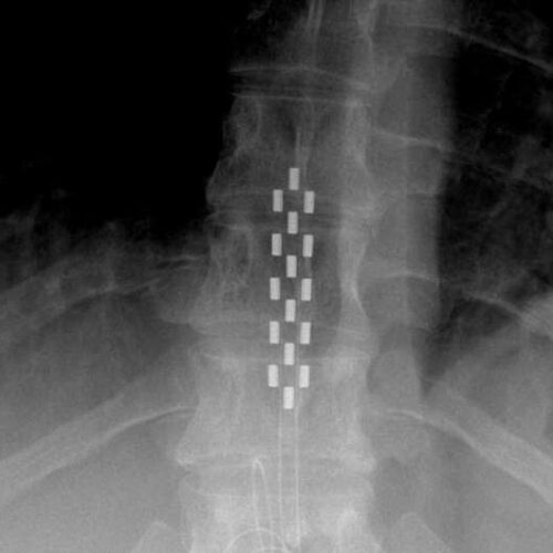 Spinal cord stimulation doesn’t help with back pain, says new review