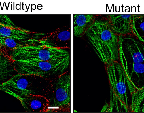 New mutation in the desmoplakin gene leads to ACM