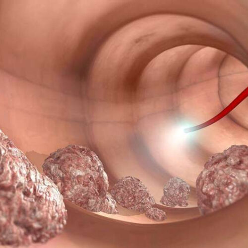 Artificial intelligence improves colonoscopy accuracy