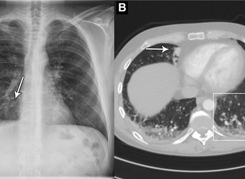 AI accurately identifies normal and abnormal chest x-rays