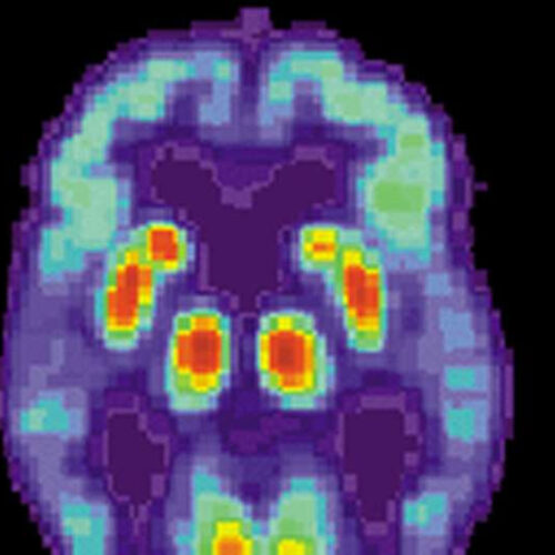 Researchers shed light on role of Tip60 enzyme in genetic disruptions that cause Alzheimer’s disease