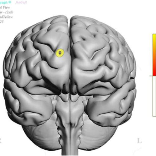 Long COVID linked to lower brain oxygen levels, cognitive problems and psychiatric symptoms