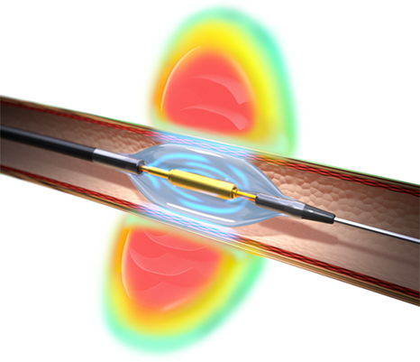 Ultrasound Catheter to Treat Hypertension