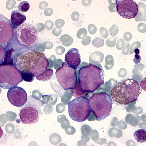 Cause of leukemia in trisomy 21