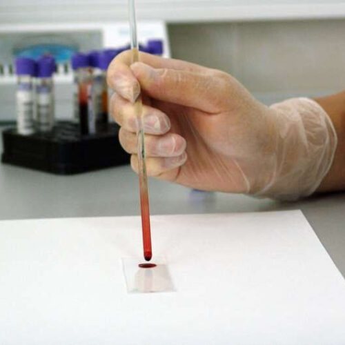HIV, hepatitis B and hepatitis C can be detected from a single drop of blood, study shows
