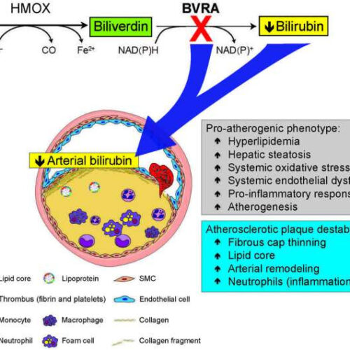 Destabilization of atherosclerotic plaque by bilirubin deficiency