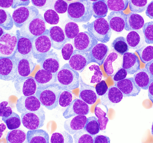 Investigational drug may improve stem cell transplantation for multiple myeloma patients