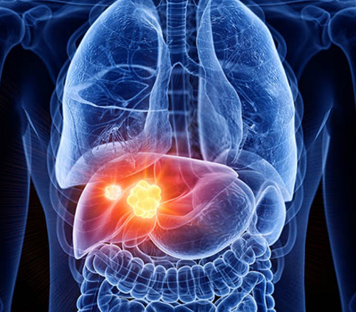 New study flips the script on liver cancer