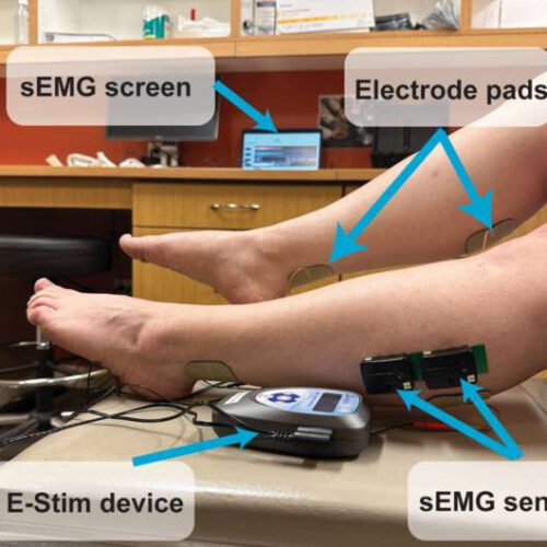 Electrical stimulation found to revitalize muscle perfusion caused by long COVID