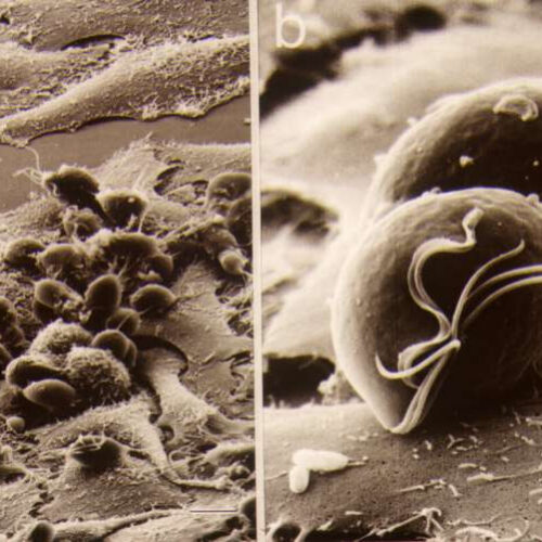 Finger-prick test developed for trichomoniasis