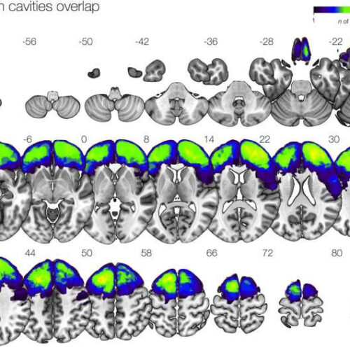 Researchers find connections in the brain involved in epileptic seizures