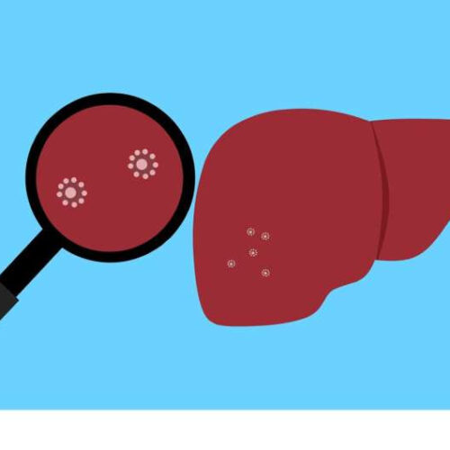 Vesicles produced by intestinal bacteria may cause a malignant cycle in patients with cirrhosis