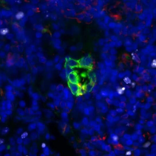 Scientists identify cellular signaling pathway as key player in metastasis